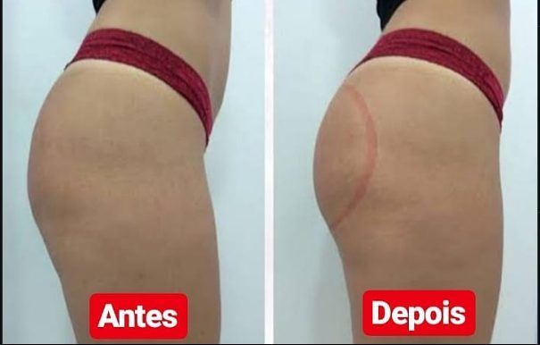 Resultado de estética corporal — antes e depois