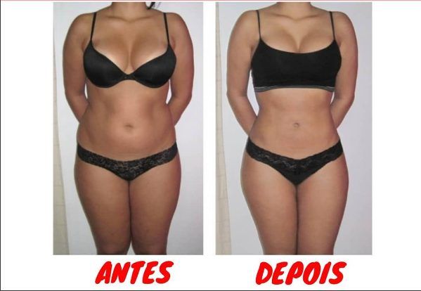 Resultado de estética corporal — antes e depois